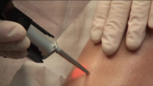Epilation laser : les bonnes pratiques professionnelles Epilation laser : les bonnes pratiques professionnelles