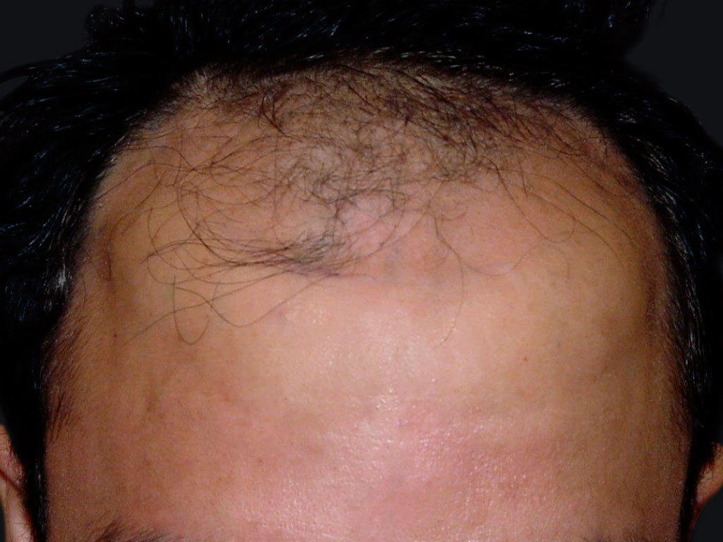 Figure 1 : Calvitie zone frontale : avant la FUE Photo Dr Boolauk Paris