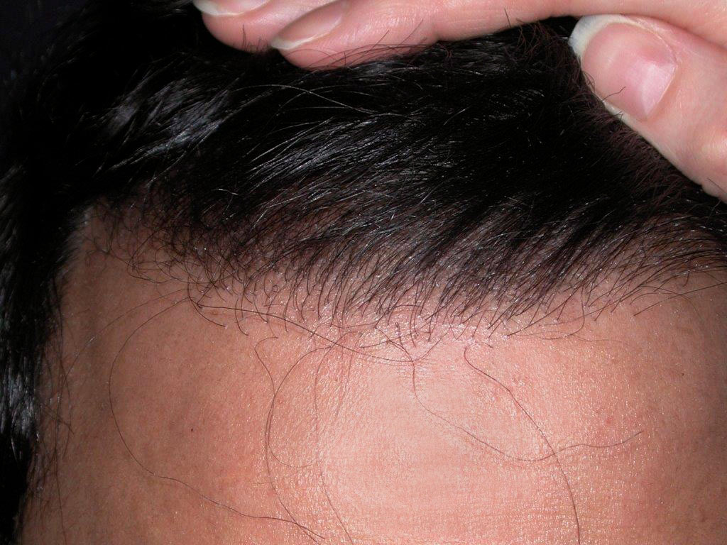 Figure 3 : Inclinaison facilitant le coiffage Photo Dr Boolauk Paris