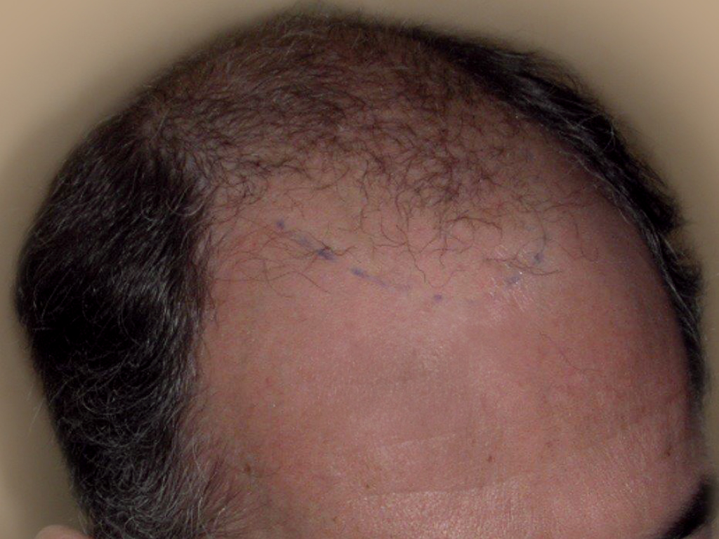Figure 7 : Avant MICRO FUE Photo Dr Boolauck Paris