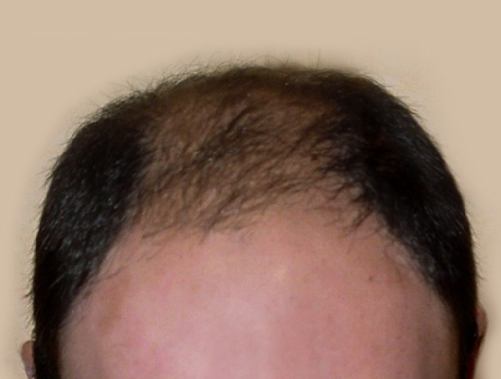 Figure 3 : Vue face - Avant MICRO FUE Photo Dr Boolauck Paris