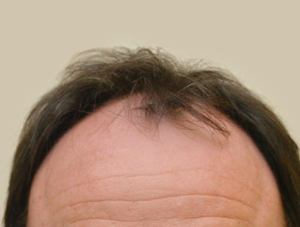 Figure 5 : Avant MICRO FUE Photo Dr Boolauck Paris