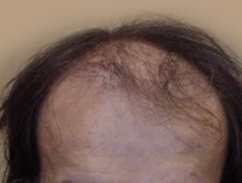 Figure 9 : Avant MICRO FUE Photo Dr Boolauck Paris