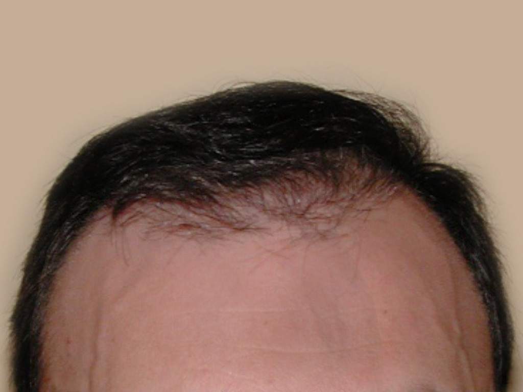 Figure 4 : Vue face - Après MICRO FUE de 3000 Greffons Photo Dr Boolauck Paris