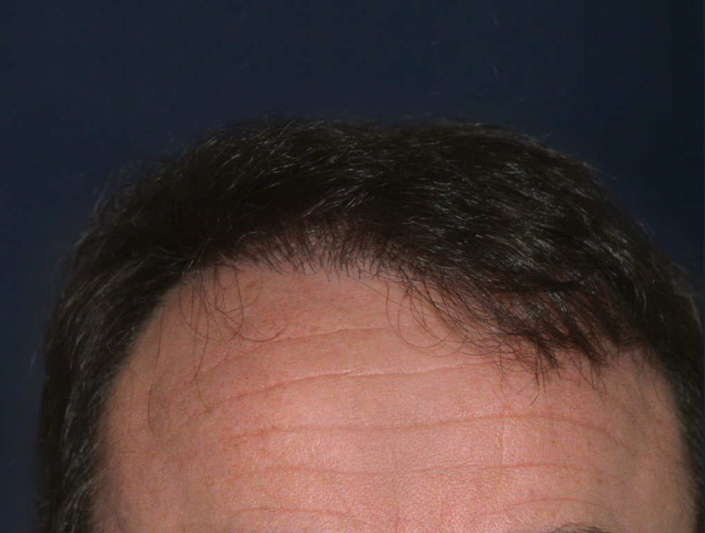 Figure 6 : Après MICRO FUE Photo Dr Boolauck Paris