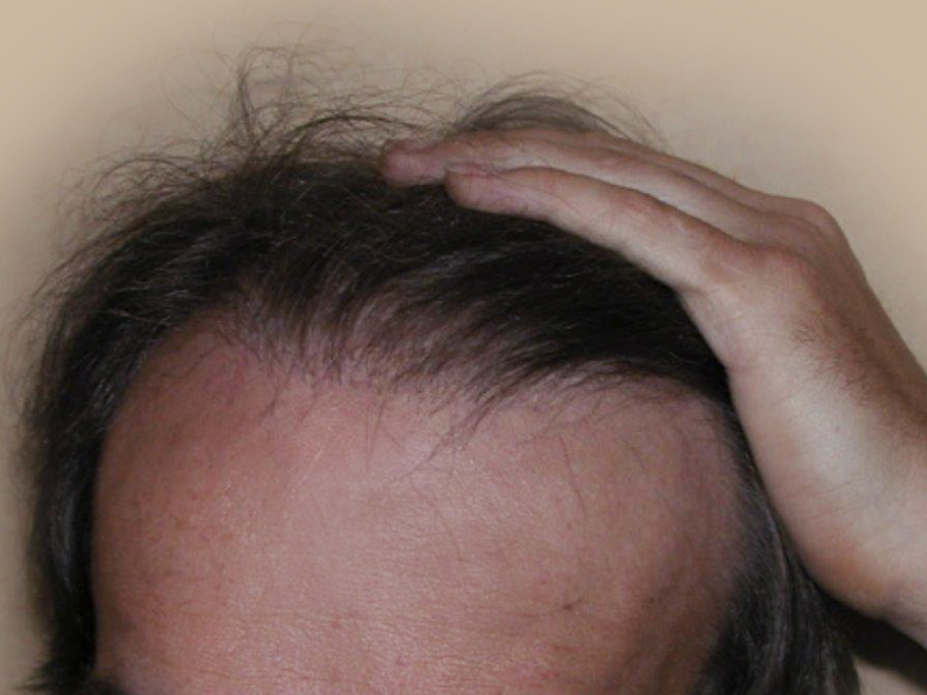 Figure 10 : Après MICRO FUE Photo Dr Boolauck Paris
