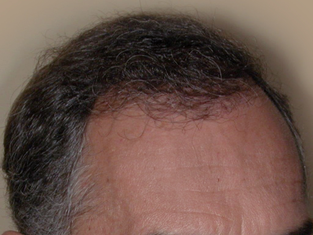 Figure 8 : Après MICRO FUE de 1500 Greffons de 1 à 2 cheveux Photo Dr Boolauck Paris