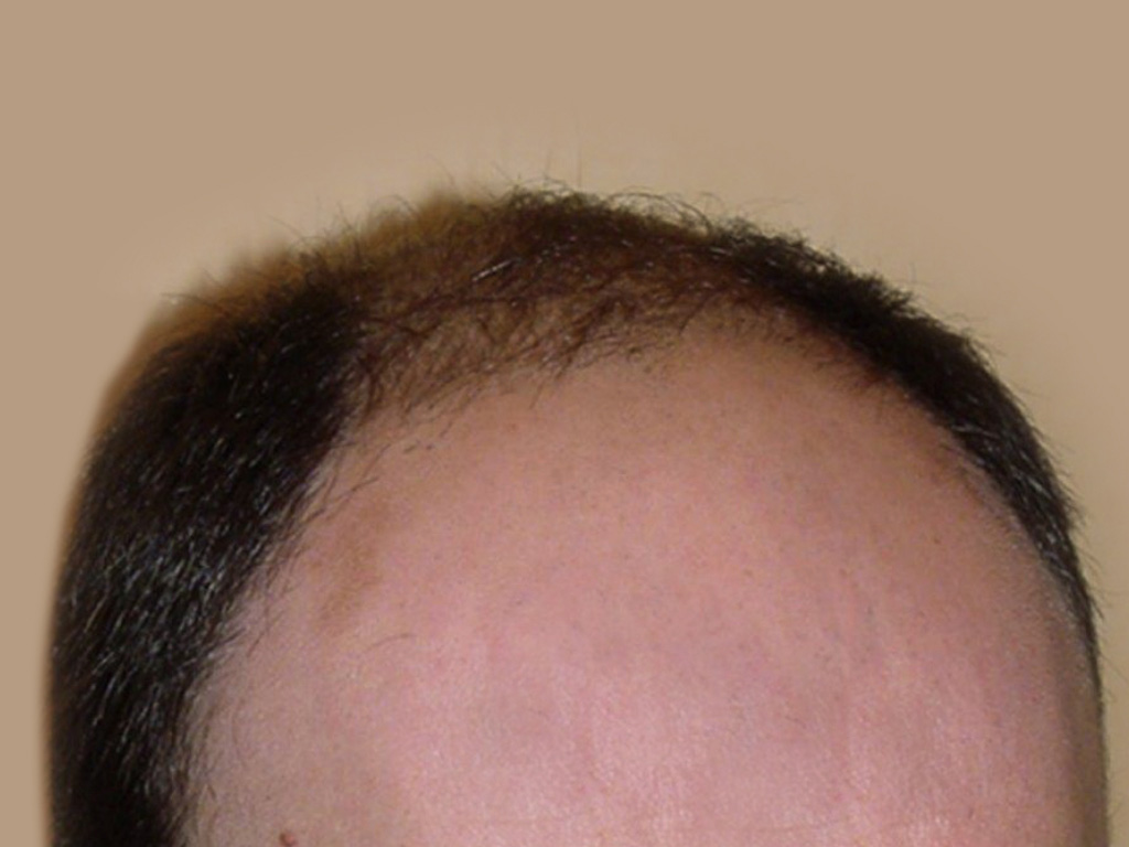 Figure 1 : Vue ¾ - Avant MICRO FUEPhoto Dr Boolauck Paris