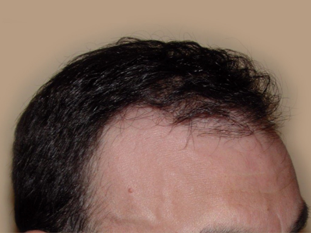 Figure 2 : Vue ¾ - Après MICRO FUE DE 3000 Greffons Photo Dr Boolauck Paris